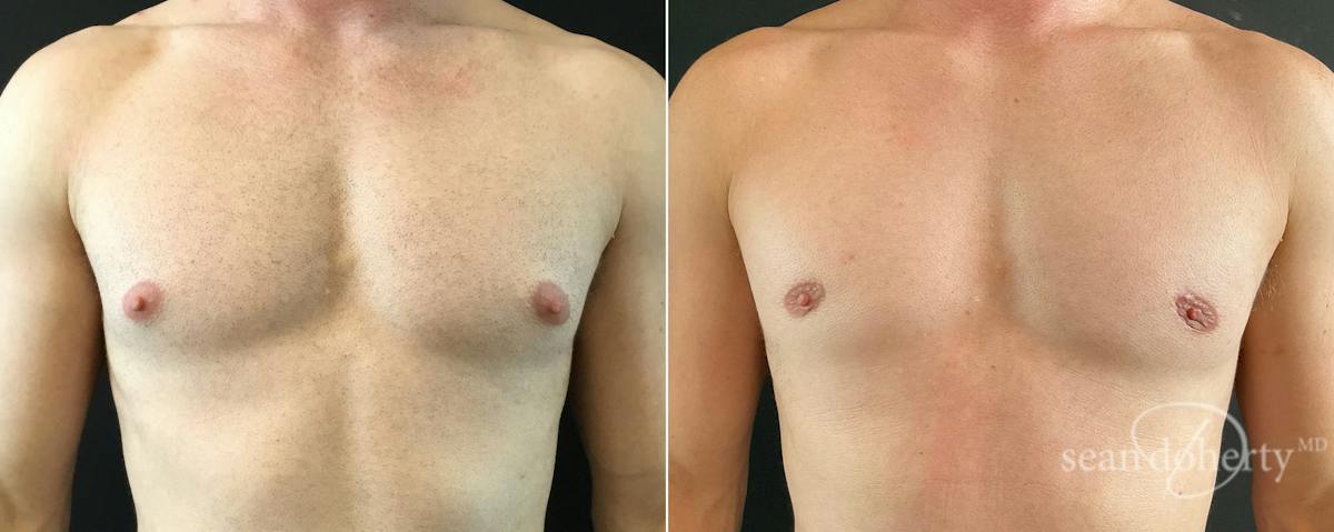 Male Breast Reduction (Gynecomastia) Before & After Gallery - Patient 228563 - Image 1