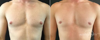 Male Breast Reduction (Gynecomastia) Before & After Gallery - Patient 228563 - Image 1