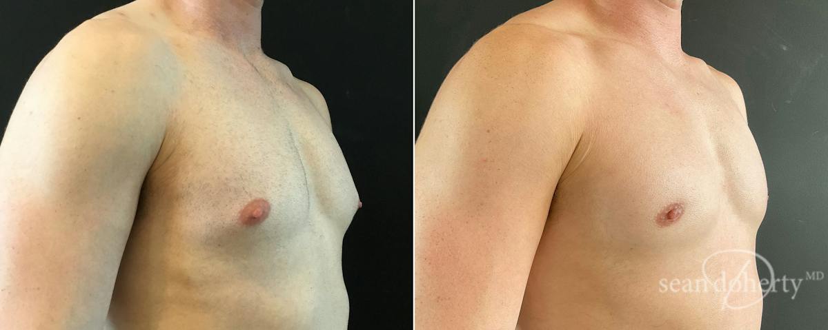 Male Breast Reduction (Gynecomastia) Before & After Gallery - Patient 228563 - Image 2