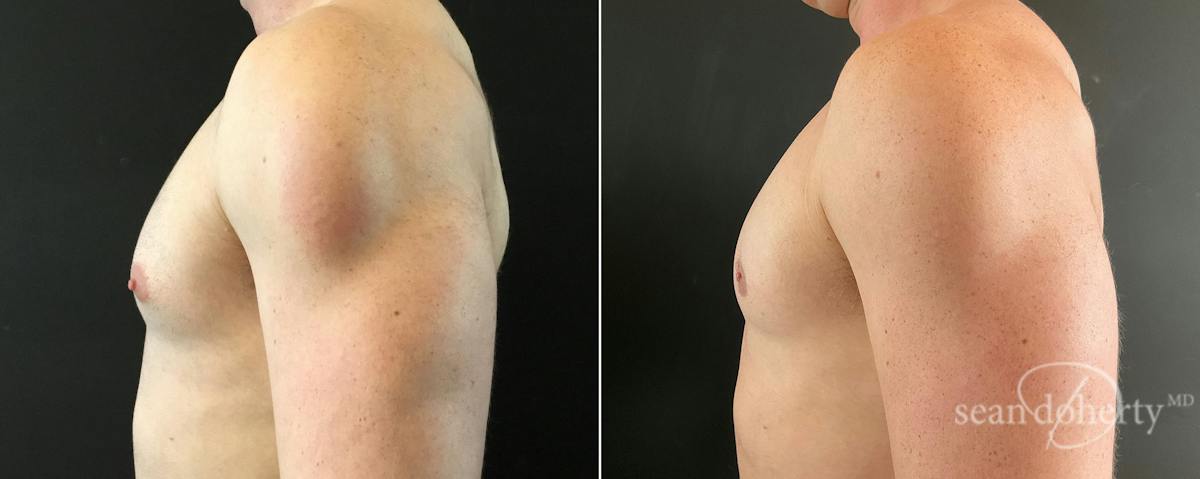Male Breast Reduction (Gynecomastia) Before & After Gallery - Patient 228563 - Image 3