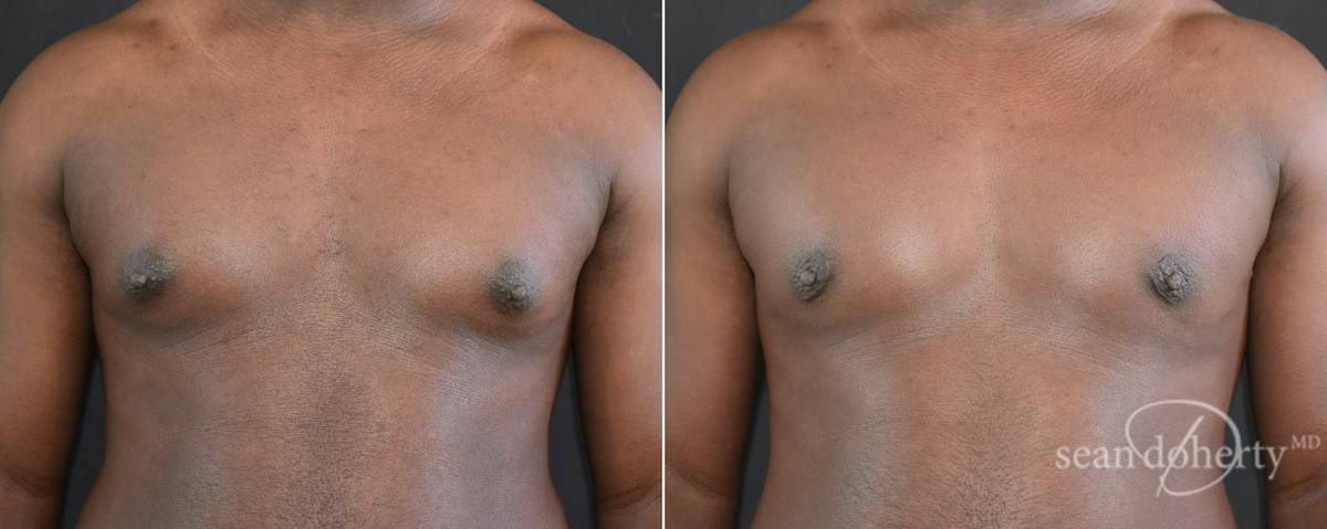 Male Breast Reduction (Gynecomastia) Before & After Gallery - Patient 217612 - Image 1