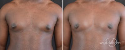 Male Breast Reduction (Gynecomastia) Before & After Gallery - Patient 217612 - Image 1