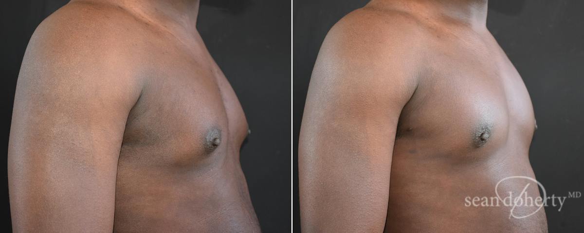 Male Breast Reduction (Gynecomastia) Before & After Gallery - Patient 217612 - Image 2