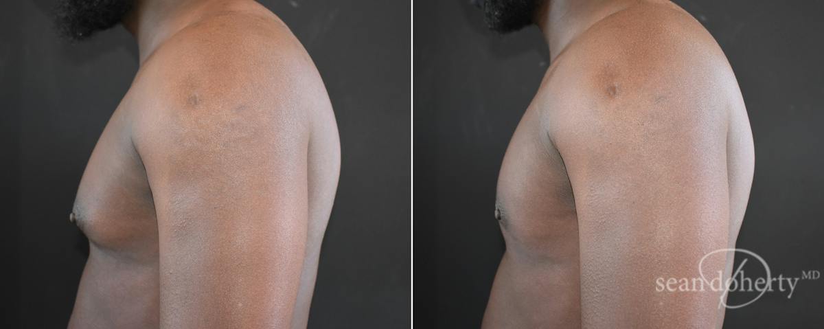 Male Breast Reduction (Gynecomastia) Before & After Gallery - Patient 217612 - Image 3