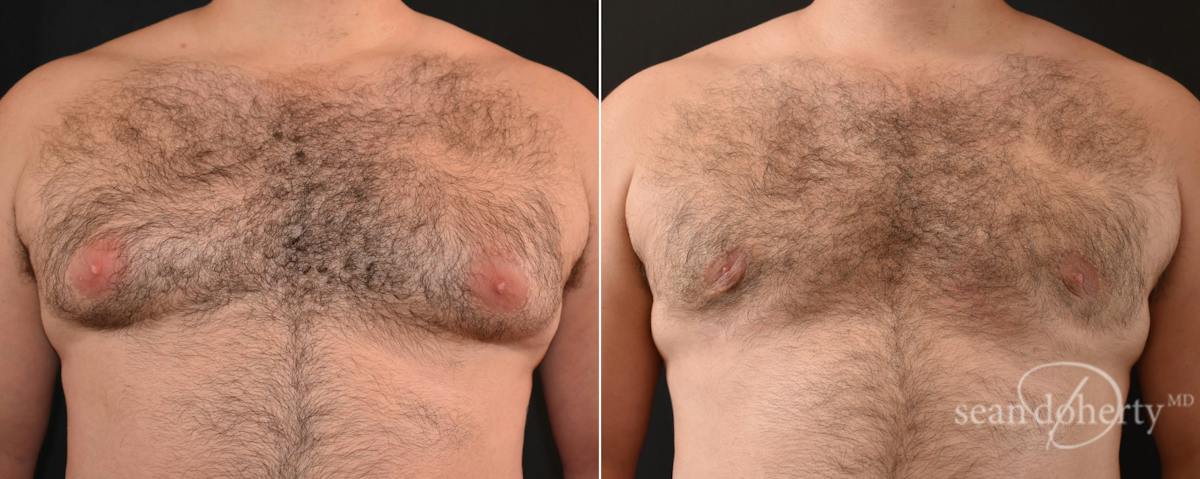 Male Breast Reduction (Gynecomastia) Before & After Gallery - Patient 348337 - Image 1
