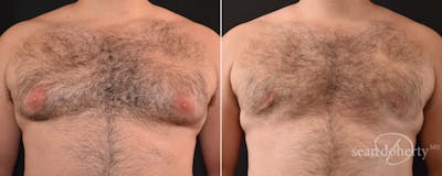Male Breast Reduction (Gynecomastia) Before & After Gallery - Patient 348337 - Image 1