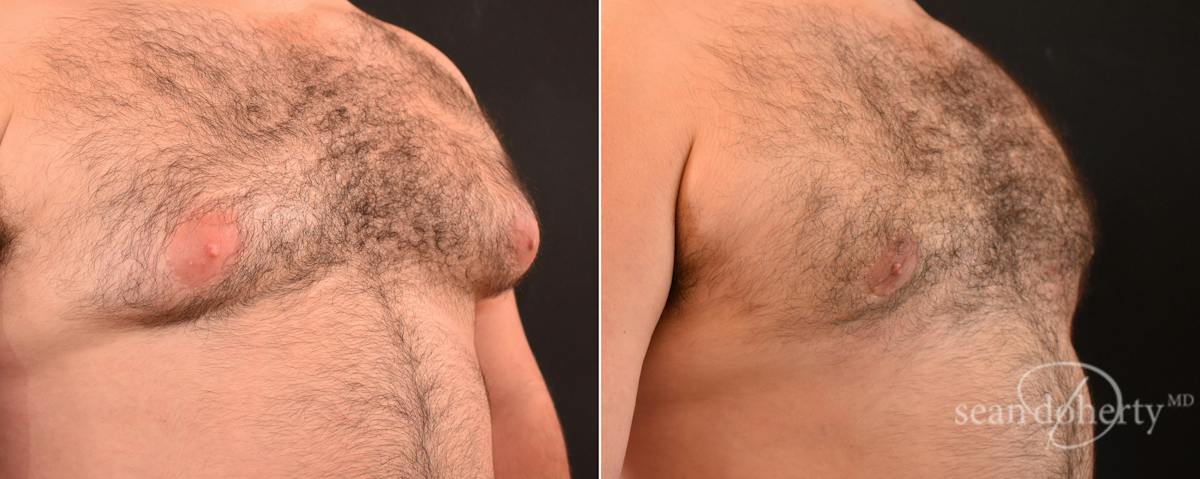 Male Breast Reduction (Gynecomastia) Before & After Gallery - Patient 348337 - Image 2