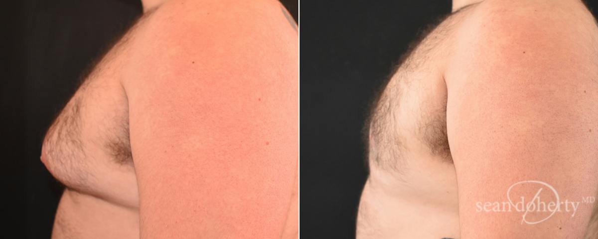 Male Breast Reduction (Gynecomastia) Before & After Gallery - Patient 348337 - Image 3