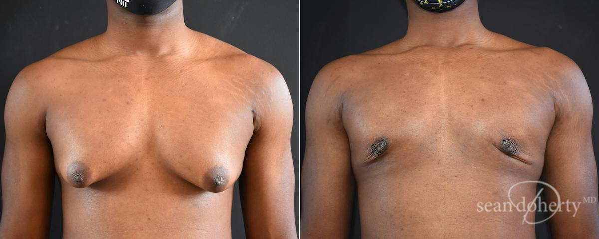Male Breast Reduction (Gynecomastia) Before & After Gallery - Patient 327841 - Image 1