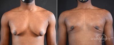 Male Breast Reduction (Gynecomastia) Before & After Gallery - Patient 327841 - Image 1
