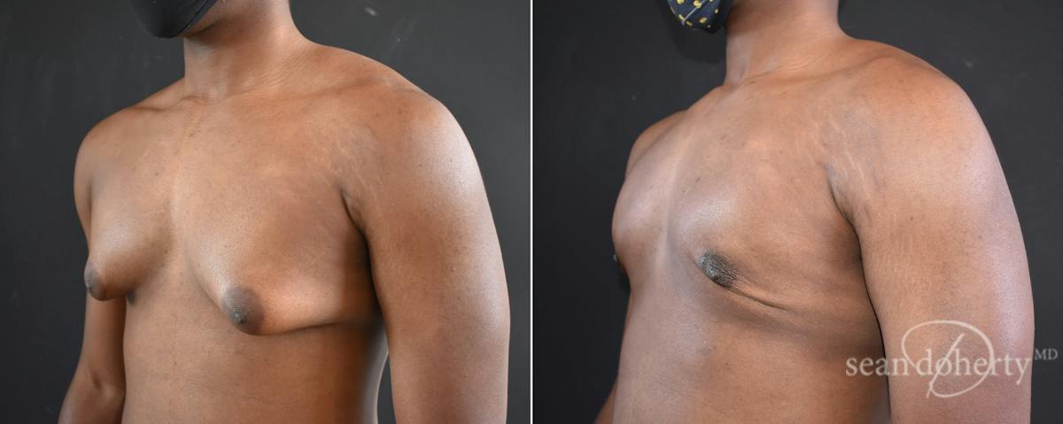Male Breast Reduction (Gynecomastia) Before & After Gallery - Patient 327841 - Image 2