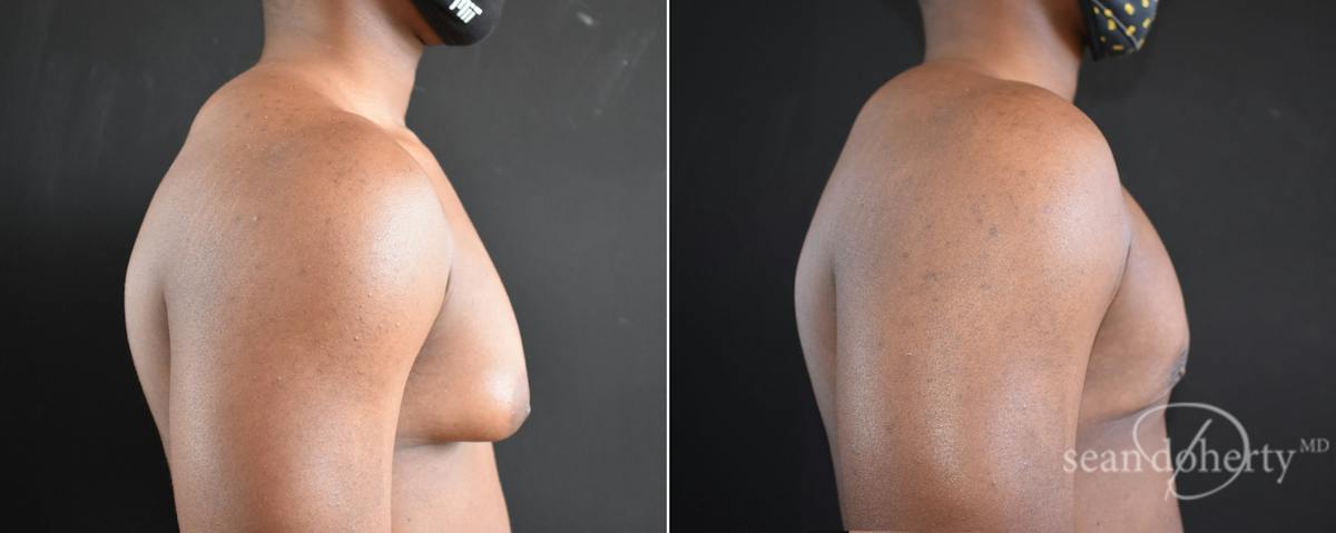 Male Breast Reduction (Gynecomastia) Before & After Gallery - Patient 327841 - Image 3
