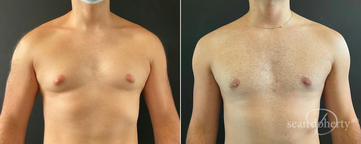 Male Breast Reduction (Gynecomastia) Before & After Gallery - Patient 263847 - Image 2