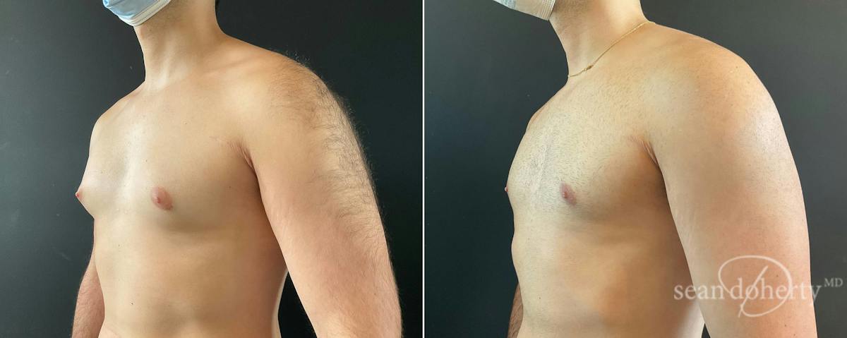 Male Breast Reduction (Gynecomastia) Before & After Gallery - Patient 263847 - Image 3