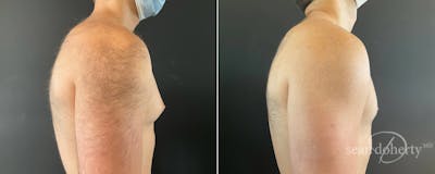 Male Breast Reduction (Gynecomastia) Before & After Gallery - Patient 263847 - Image 1