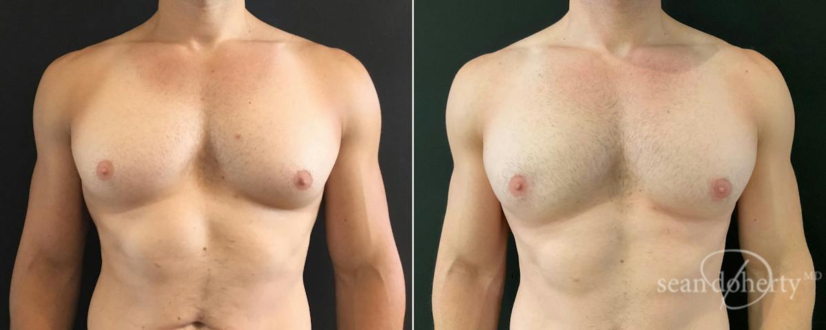Male Breast Reduction (Gynecomastia) Before & After Gallery - Patient 257332 - Image 1