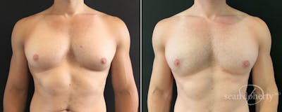 Male Breast Reduction (Gynecomastia) Before & After Gallery - Patient 257332 - Image 1