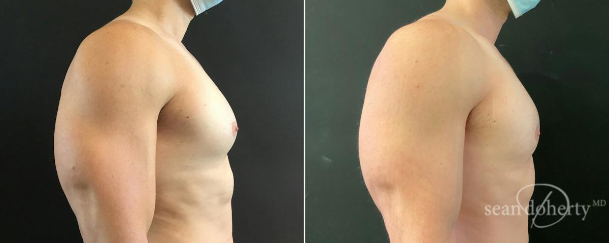 Male Breast Reduction (Gynecomastia) Before & After Gallery - Patient 257332 - Image 3