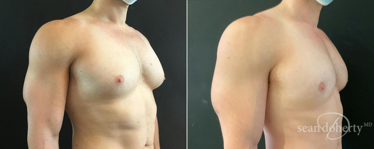 Male Breast Reduction (Gynecomastia) Before & After Gallery - Patient 257332 - Image 2