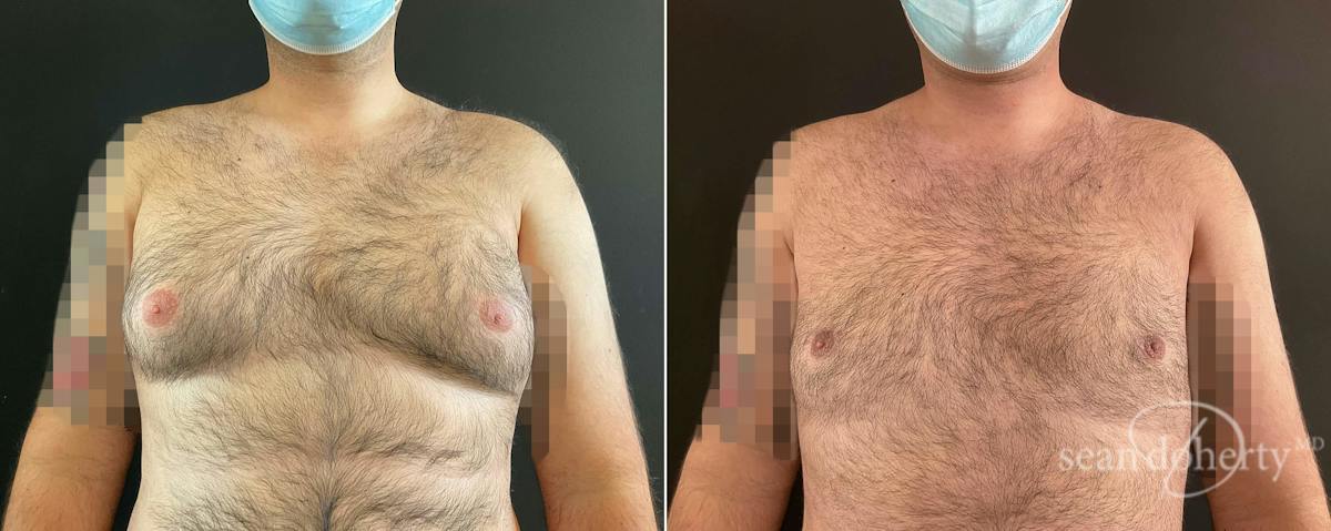 Male Breast Reduction (Gynecomastia) Before & After Gallery - Patient 344750 - Image 1