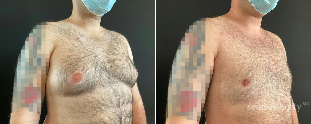 Male Breast Reduction (Gynecomastia) Before & After Gallery - Patient 344750 - Image 2