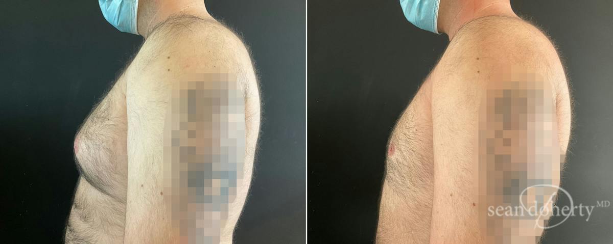 Male Breast Reduction (Gynecomastia) Before & After Gallery - Patient 344750 - Image 3