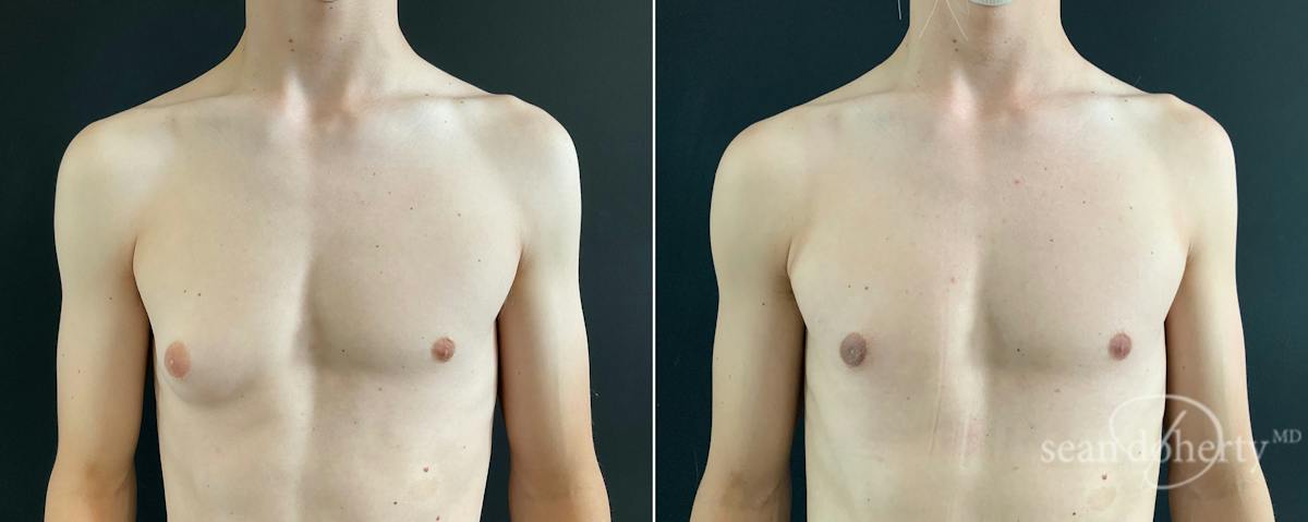 Male Breast Reduction (Gynecomastia) Before & After Gallery - Patient 172790 - Image 1