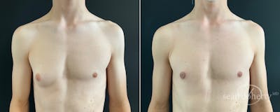 Male Breast Reduction (Gynecomastia) Before & After Gallery - Patient 172790 - Image 1