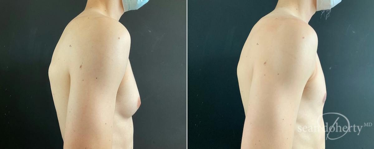 Male Breast Reduction (Gynecomastia) Before & After Gallery - Patient 172790 - Image 3