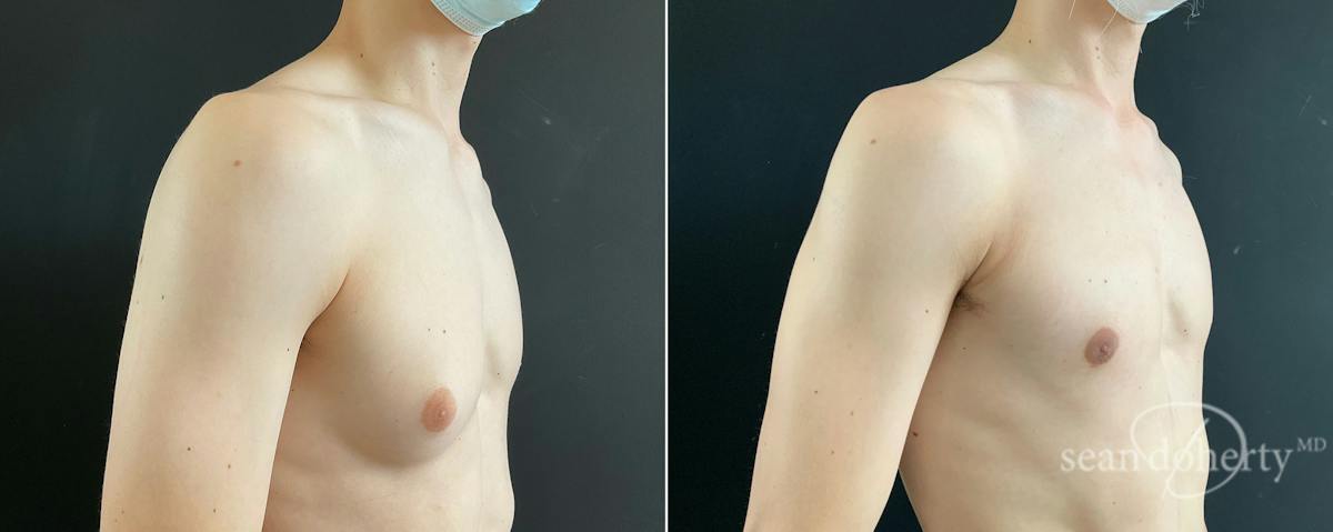 Male Breast Reduction (Gynecomastia) Before & After Gallery - Patient 172790 - Image 2