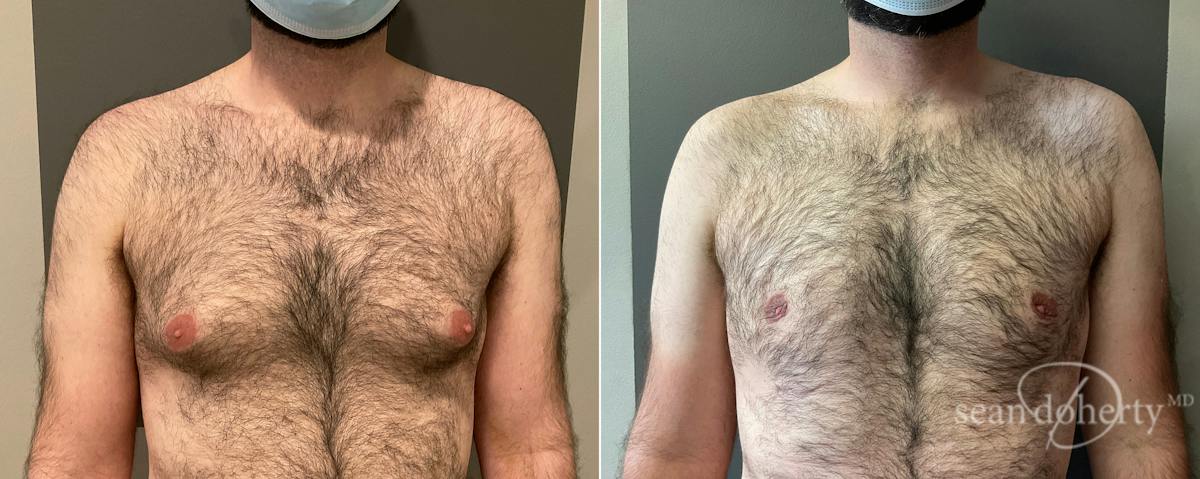 Male Breast Reduction (Gynecomastia) Before & After Gallery - Patient 129621 - Image 1