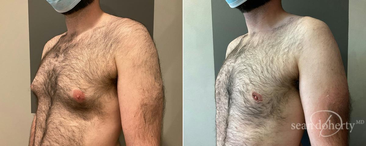 Male Breast Reduction (Gynecomastia) Before & After Gallery - Patient 129621 - Image 2