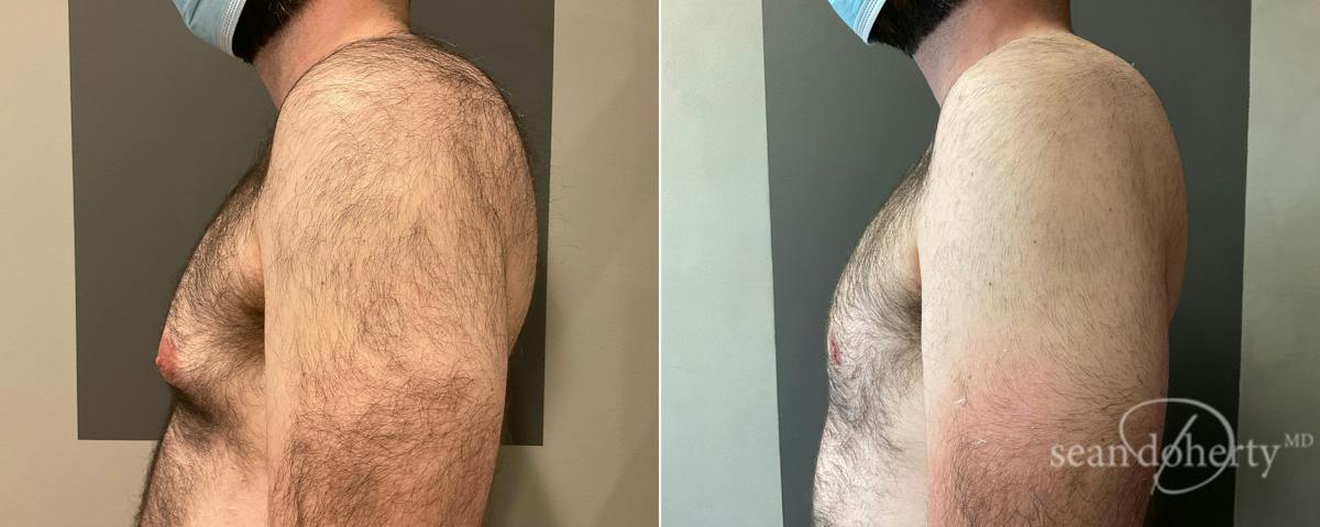 Male Breast Reduction (Gynecomastia) Before & After Gallery - Patient 129621 - Image 3
