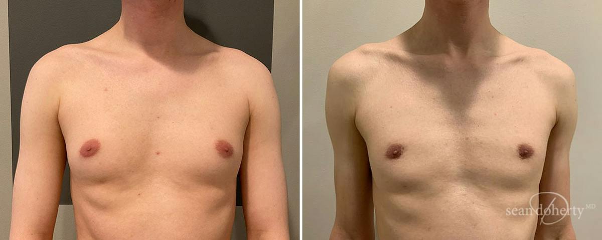 Male Breast Reduction (Gynecomastia) Before & After Gallery - Patient 375369 - Image 1