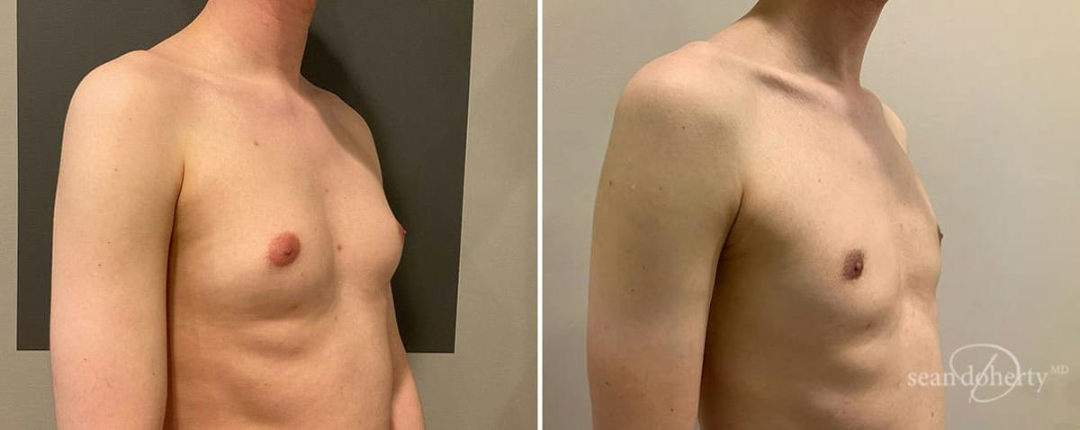 Male Breast Reduction (Gynecomastia) Before & After Gallery - Patient 375369 - Image 2