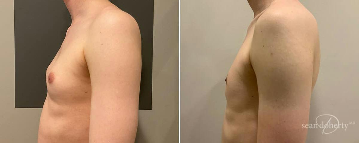 Male Breast Reduction (Gynecomastia) Before & After Gallery - Patient 375369 - Image 3