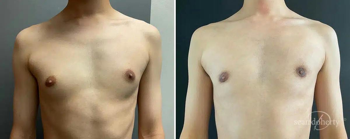 Male Breast Reduction (Gynecomastia) Before & After Gallery - Patient 531939 - Image 1