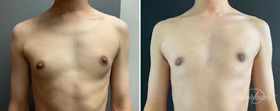 Male Breast Reduction (Gynecomastia) Before & After Gallery - Patient 531939 - Image 1
