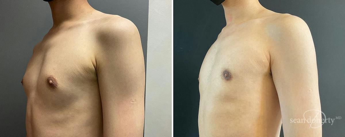 Male Breast Reduction (Gynecomastia) Before & After Gallery - Patient 531939 - Image 2