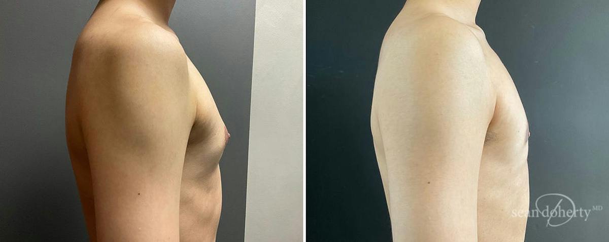 Male Breast Reduction (Gynecomastia) Before & After Gallery - Patient 531939 - Image 3