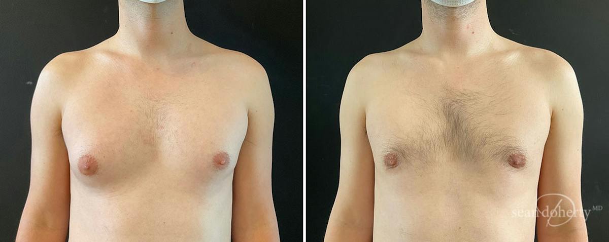 Male Breast Reduction (Gynecomastia) Before & After Gallery - Patient 312017 - Image 1