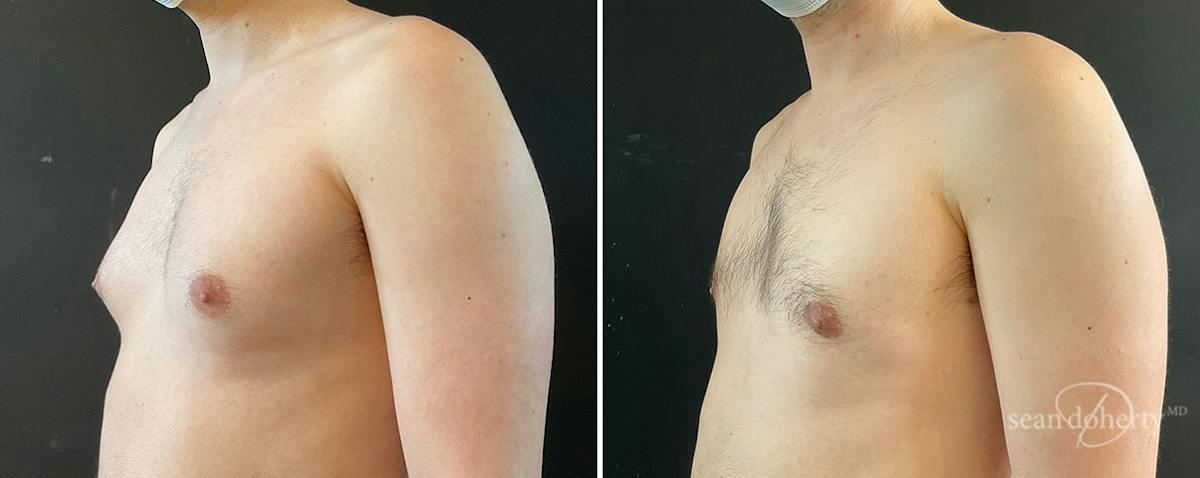 Male Breast Reduction (Gynecomastia) Before & After Gallery - Patient 312017 - Image 2