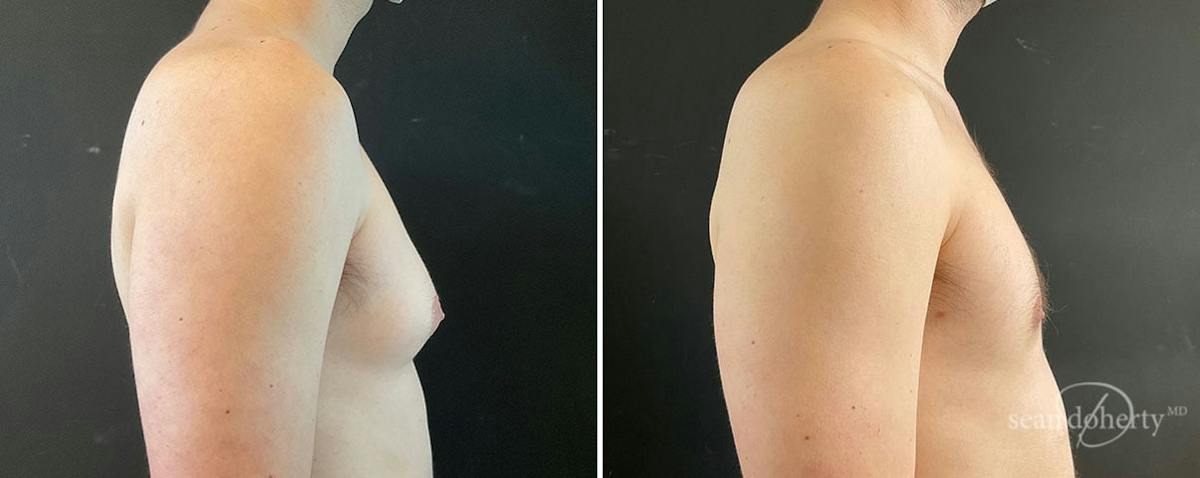 Male Breast Reduction (Gynecomastia) Before & After Gallery - Patient 312017 - Image 3