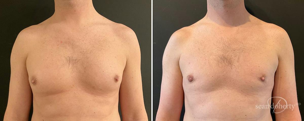 Male Breast Reduction (Gynecomastia) Before & After Gallery - Patient 154663 - Image 1