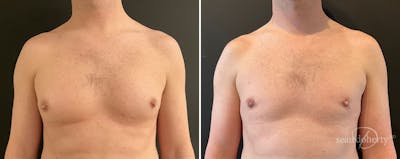 Male Breast Reduction (Gynecomastia) Before & After Gallery - Patient 154663 - Image 1