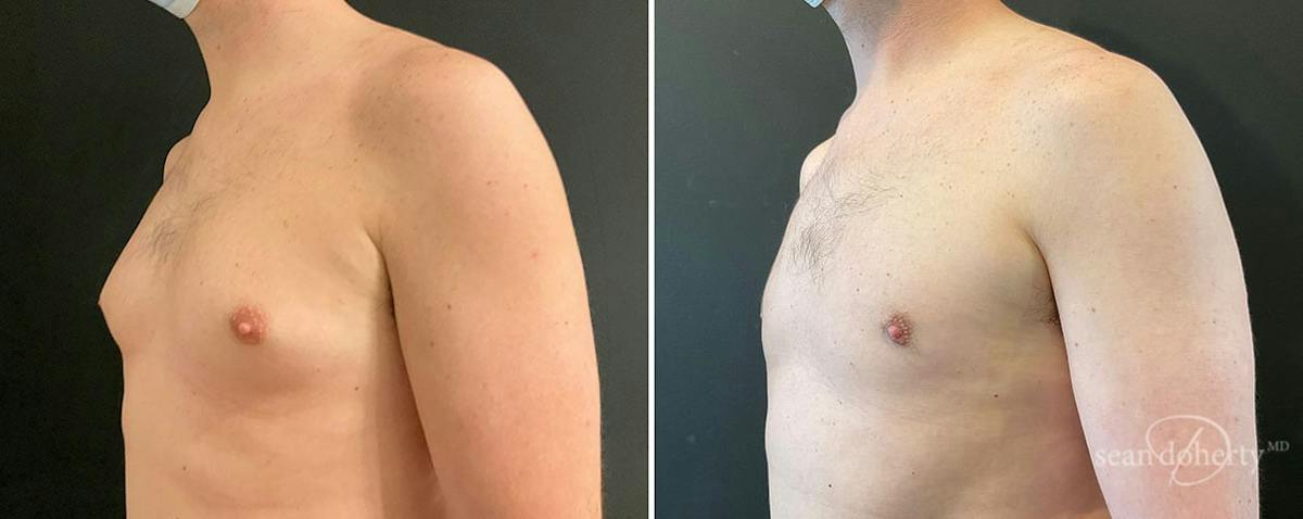 Male Breast Reduction (Gynecomastia) Before & After Gallery - Patient 154663 - Image 2