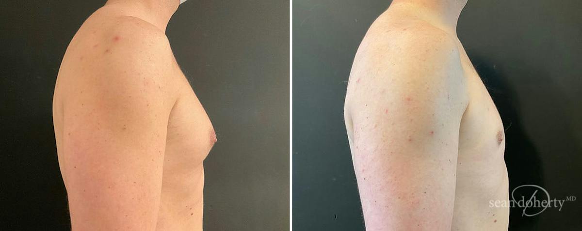 Male Breast Reduction (Gynecomastia) Before & After Gallery - Patient 154663 - Image 3