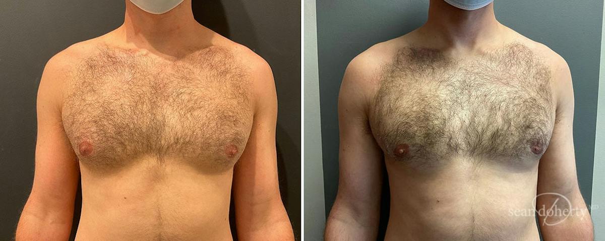 Male Breast Reduction (Gynecomastia) Before & After Gallery - Patient 356136 - Image 1
