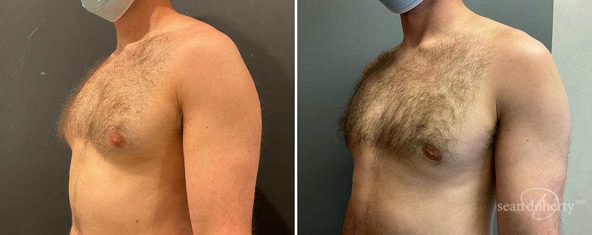 Male Breast Reduction (Gynecomastia) Before & After Gallery - Patient 356136 - Image 2