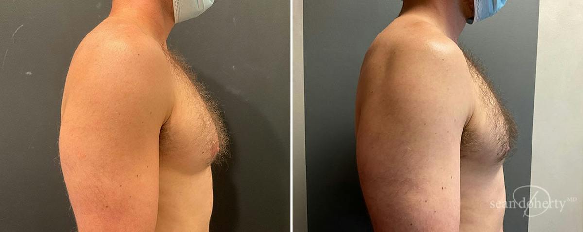 Male Breast Reduction (Gynecomastia) Before & After Gallery - Patient 356136 - Image 3
